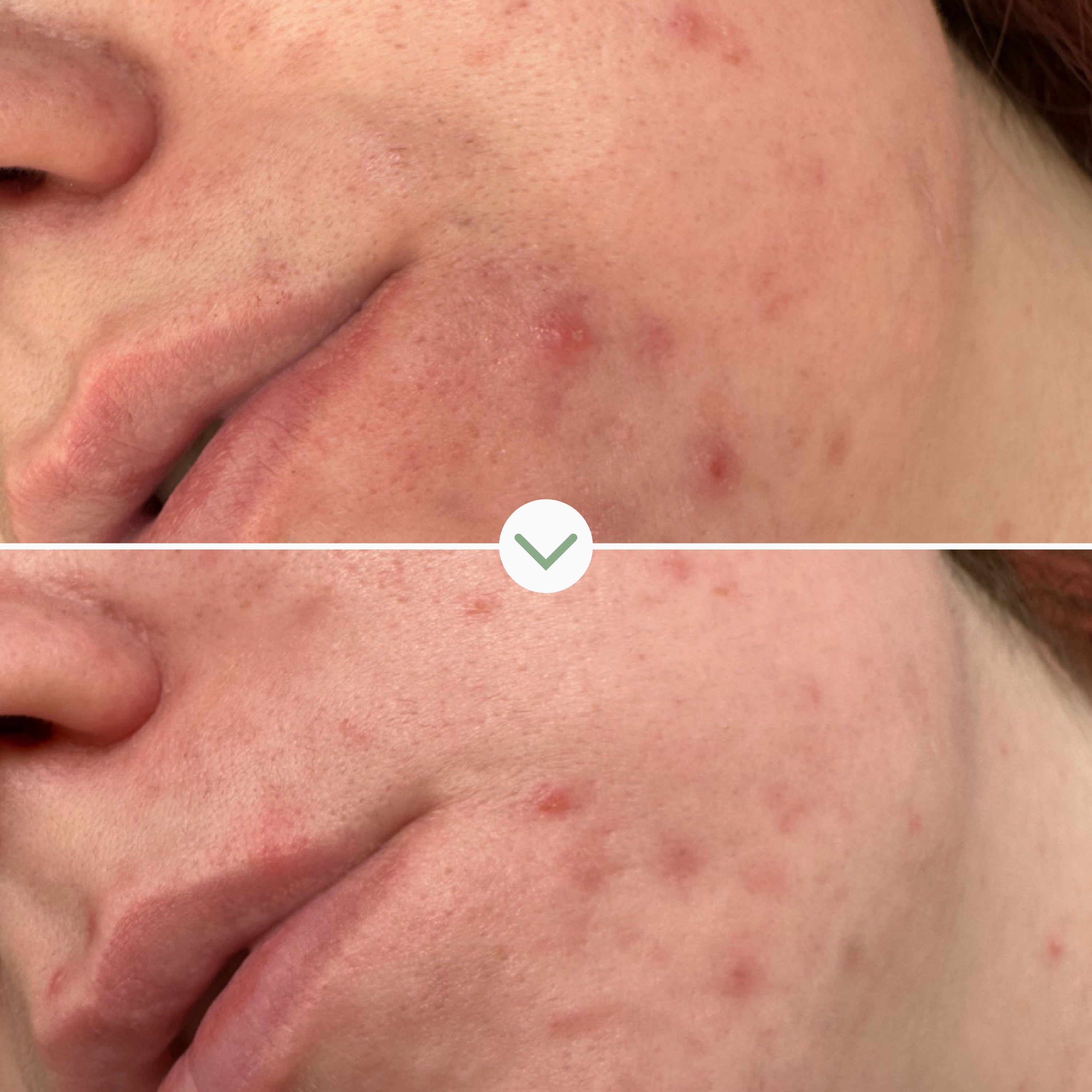 Comparativa antes y después con Mini PHAZE, piel más suave, luminosa y sin signos de irritación.